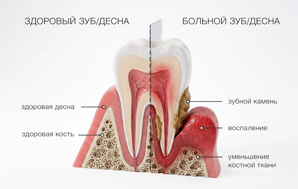 Показания к ультразвуковой чистке зубов аппаратом VECTOR